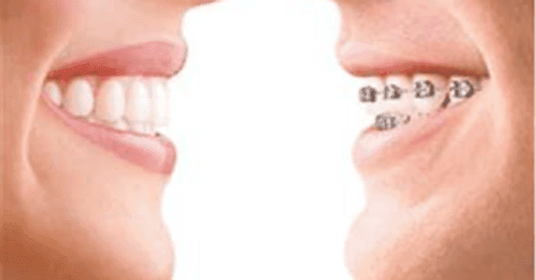 Why Are Braces So Expensive?